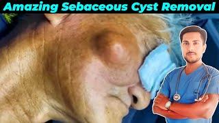 Amazing Sebaceous Cyst Removal | Safe and Painless Procedure Must Watch | Educational Content.