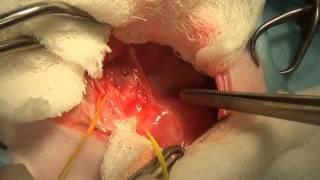 Surgical treatment of the vascular ring pathology