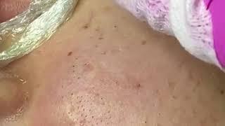 removing cystic acne | чёрные точки | прыщи выдавливание| акне