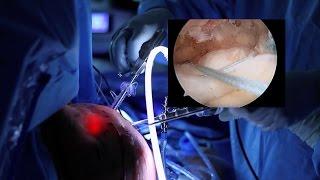 Rotator Cuff Repair Surgery | Vail, CO