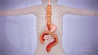 Long-Segment Colonic Interposition for Esophageal Atresia: 3D Animation