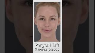 Ponytail Lift - KAO Plastic Surgery - Check Channel For Full Video #ponytaillift #ponytailfacelift