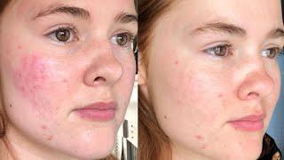 MICRONEEDLING bei ESMERELLA STUDIO Braunschweig