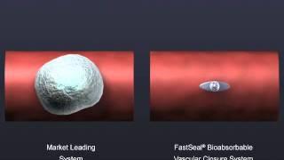 FastSeal Vascular Access Closure System Deployed Size Comparison