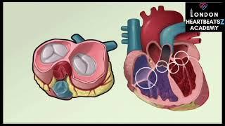 Valvular heart disease : MS, MR, AS, AR Physiology, Hemodynamics, Murmurs complex multiple mixed VHD