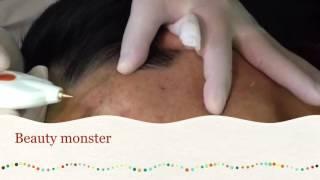 Beauty Monster (with Plasma tip) - Blemish, Pigmentation