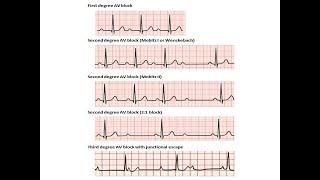 ECG course: AV blocks, Dr. Sherif Altoukhy