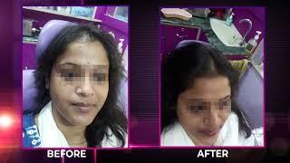 Hair Treatment | PRP | Cosmogene | Kolkata