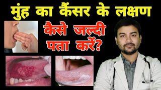 ओरल कैंसर के लक्षण ! How to detect oral cancer in early stage? In hindi by Dr Animesh MS?