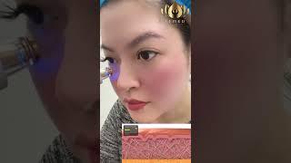 TempSure [ LeMed Clinic]