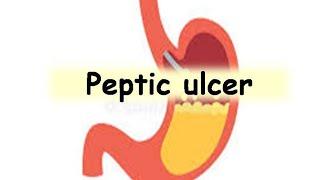 Peptic ulcer- pathophysiology notes for medical students