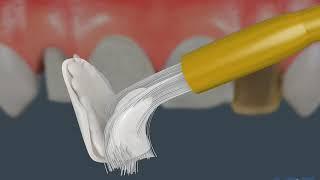 Dreaming about veneers? Watch this video now!