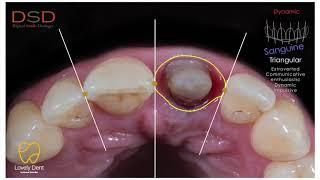 Press keramik qapaq (Lovely Dent by dr Khayal Samadov)