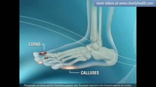 Diabetes: Foot care