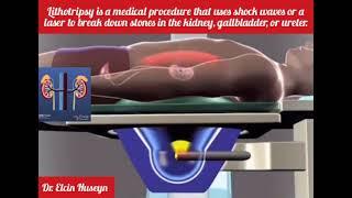 Lithotripsy is a medical procedure that uses shock waves or a laser to break down stones in the body