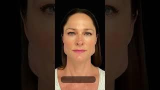 Botox for Facial Slimming Before and After- MUST WATCH