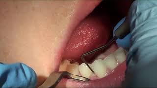 Periodontal Probing On Patient