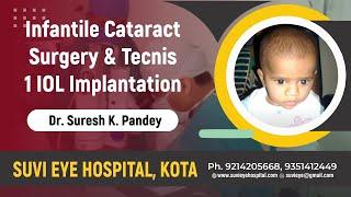 Infantile Cataract Surgery &  Tecnis 1 IOL Implantation Dr Suresh K Pandey, SuVi Eye Kota, India.mpg