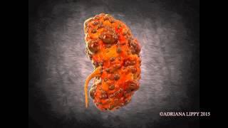 Polycystic Kidney Animation