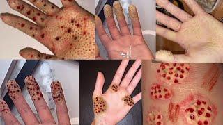 TRYPOPHOBIA *TRIGGER WARNING TRYPOPHOBIA* | SFX MAKEUP