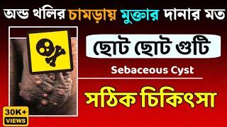 অন্ড থলির চামড়ায় টিউমার||Sebaceous cyst on scrotum||অন্ডকোষ গুটিকা সঠিক চিকিৎসা