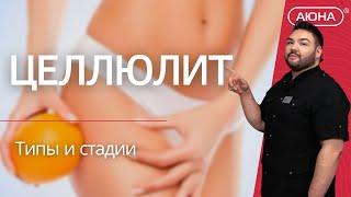 ЦЕЛЛЮЛИТ: типы и стадии