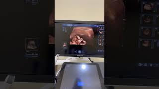 Homiladorlikda bola jinsini ko’rish#shorts#shortvideo#3d#uzi#dopler