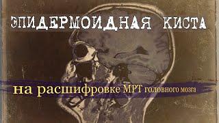 ЭПИДЕРМОИДНАЯ КИСТА головного мозга и ее симптомы на РАСШИФРОВКЕ МРТ (второе мнение)