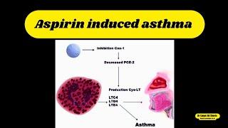 aspirin induced asthma | Dr Liaqat Ali Shorts | #shorts