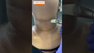 Acanthosis nigricans (black neck) at skinaa clinic | Viral #shorts