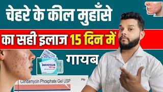 कील मुहाँसे 15 दिन मे गायब | Best Treatment For Acne And Pimples