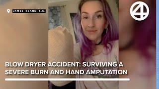 Woman's Journey After Hand Amputation Due to Blow Dryer Burn