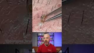  Ingrown Hair Alert!  Watch as they conquer this gnarly skin invader! #DermReacts #DoctorReacts