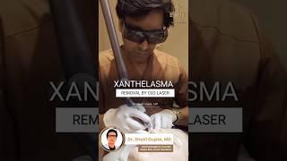 Xanthelasma Removal by CO2 Laser | Fat deposit removal treatment |#xanthelasma #shortvideo #skincare