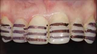 Керамические виниры. Porcelain veneers. Emax. Carillas Dentales. 牙齿镶