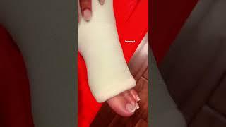 Toes sticking out of my leg cast #legcast #foot #pedicurenails #pedicure