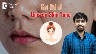 What is Uneven Skin Tone? 3 Ways to Get Rid of It #unevenskintone -Dr.Rajdeep Mysore|Doctors' Circle