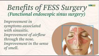 Benefits of FESS Surgery