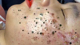 Big Cystic Acne Blackheads Extraction Blackheads & Milia, Whiteheads Removal Pimple Popping # 1632