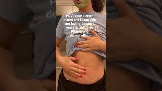 Getting rid of my stretch marks and loose skin  #dermaroller #stretchmarks #postpartumbelly