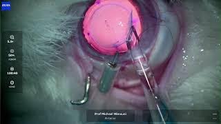 Precise Vision Endothelial Keratoplasty