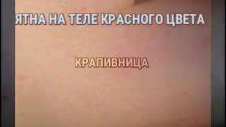 Красные пятна на теле