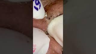Skincare | Blackheads Removal #483 #tweezers skincare #blackheads blackheads