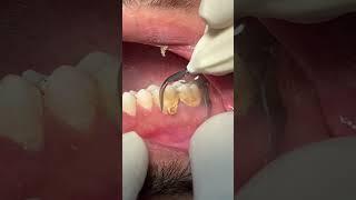 Cleaning teeth  #dental #scaling #satisfying