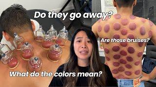 What They DON'T Tell You About Cupping Marks...