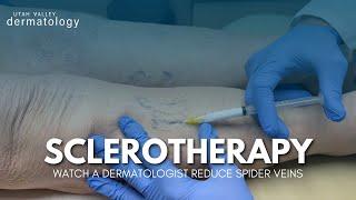 Watch These Spider Veins Disappear! Sclerotherapy | Utah Valley Dermatology