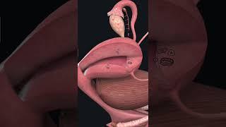 Understanding Adenomyosis: Endometrial Tissue Growth in the Uterine Wall
