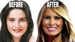 Melania Trump's Plastic Surgery Secrets Exposed (2024)