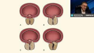 Гиперплазия предстательной железы (Горгоцкий И. А.)