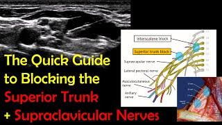 SUPERIOR TRUNK BLOCK - A 5-Minute "How-To" Guide